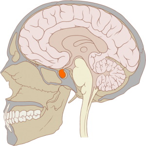 Diabetes insipidus hypofyse